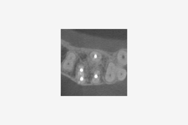 CBCT endodoncia molar
