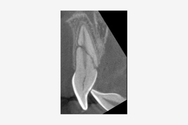 CBCT fractura de Central